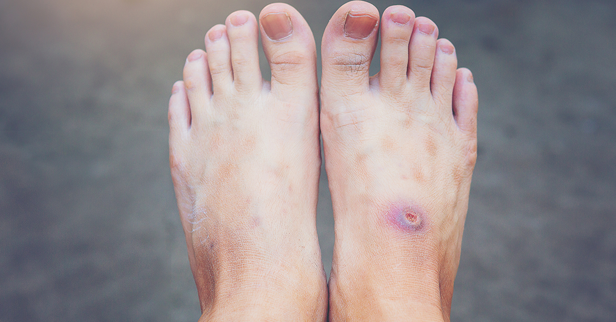 Diabetul articulațiilor degetelor de la picioare - Dureri picioare diabet