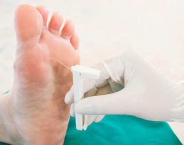 diabetul articulațiilor degetelor de la picioare